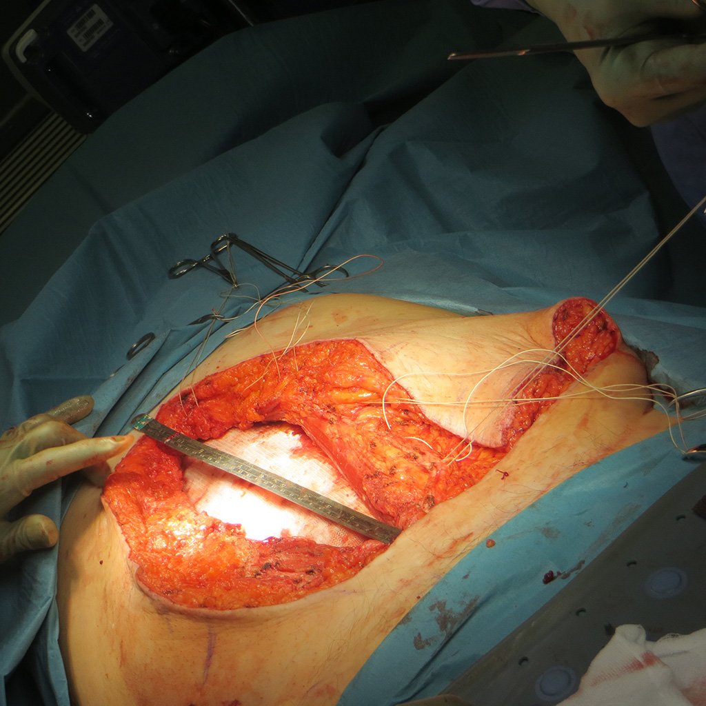 Case York_8_Defect Size
