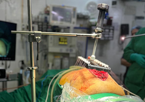 Case Reports Hernia_India Hybrid