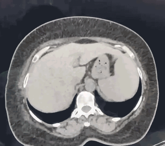 Mahadar-(Mumbai)---Open-Approach-15cm-Pre-op-CT