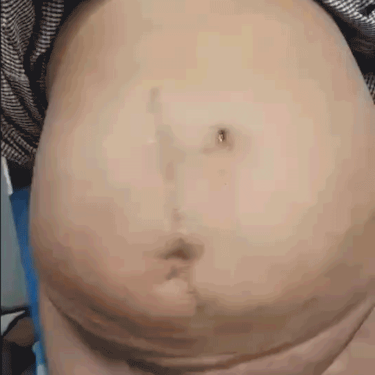 Mahadar-(Mumbai)---Open-Approach-15cm-Pre-op-coughing_small