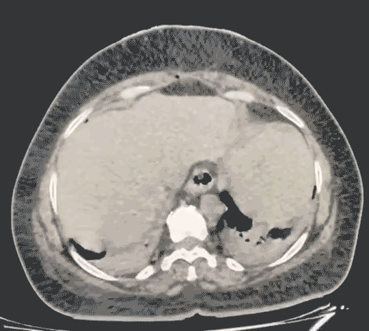 Mahadar-(Mumbai)---Open-Approach-Post-op-CT