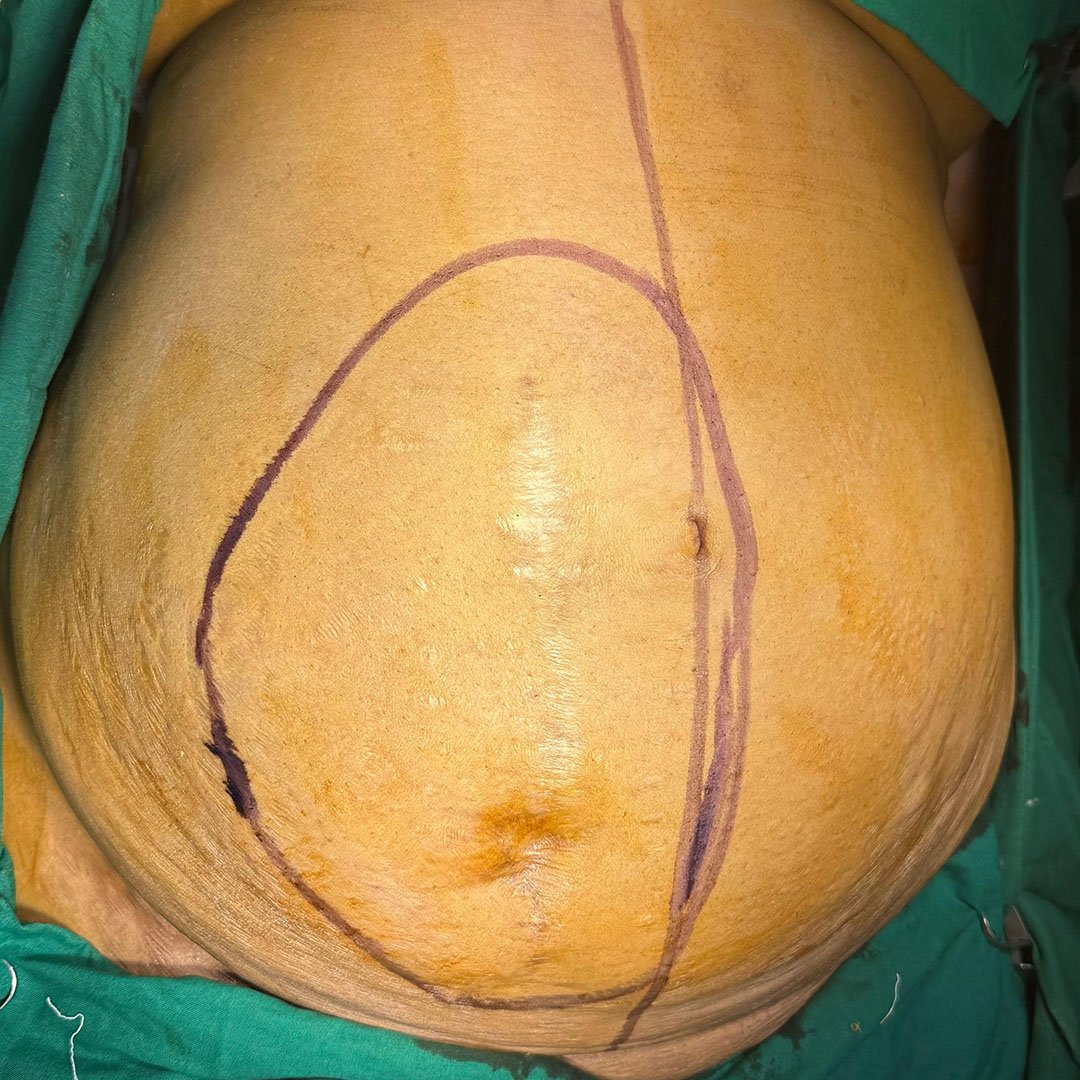 Pre-op