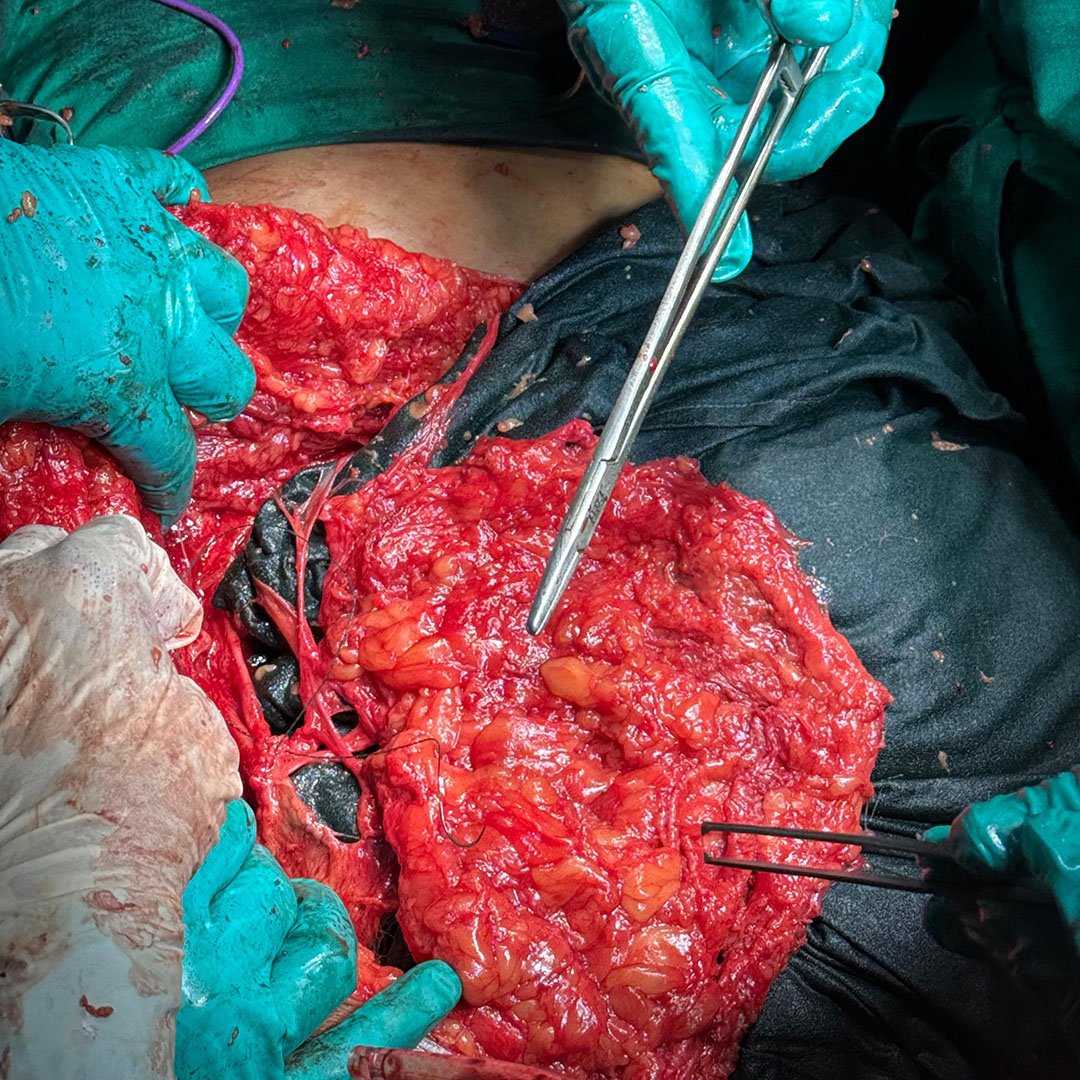 Intra-operative Exposure