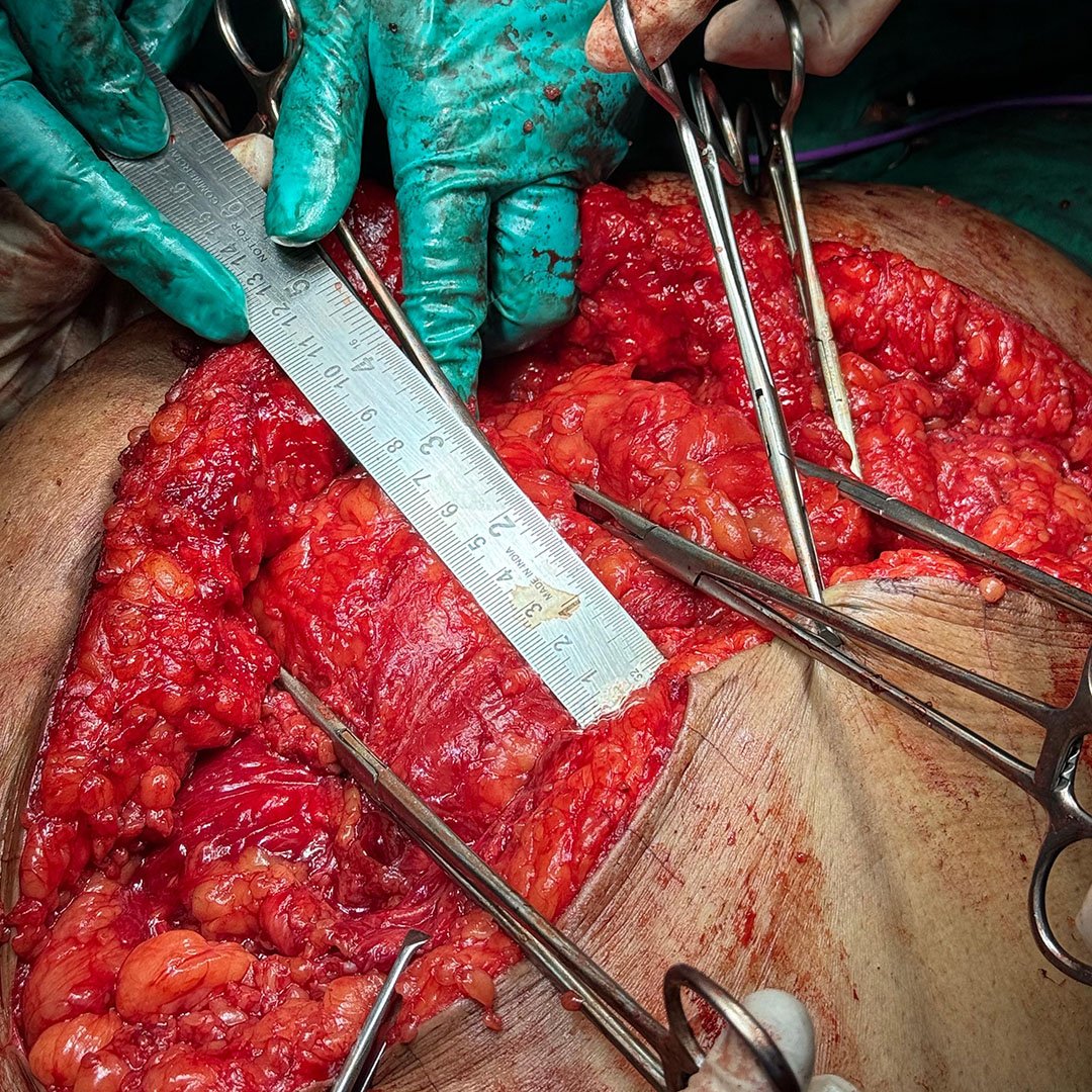 Fascial Defect Measurement