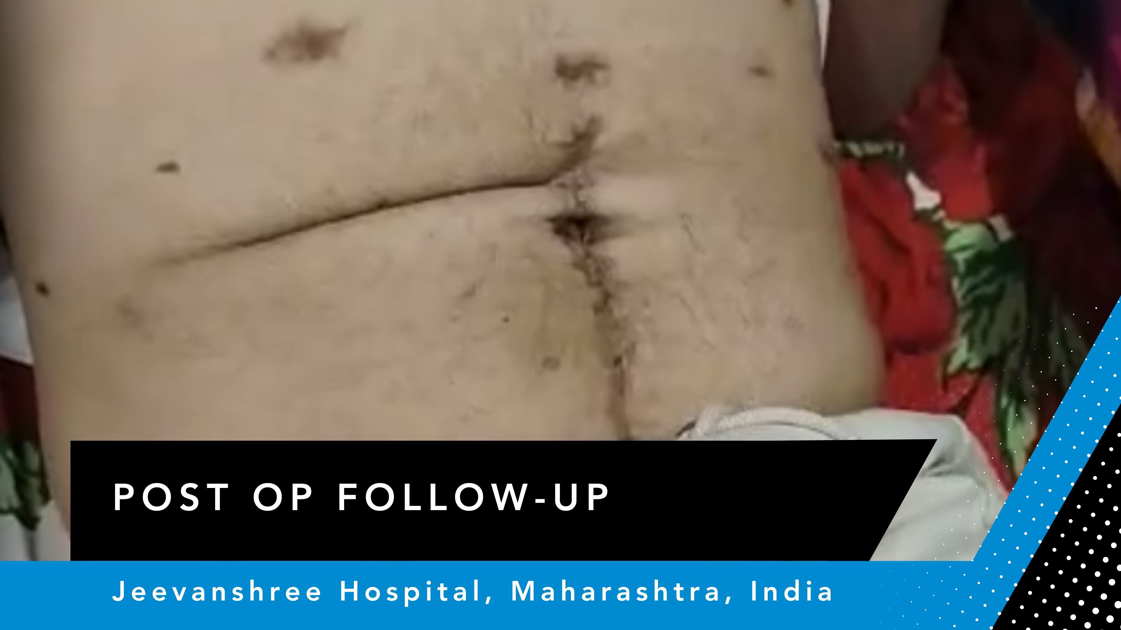 Cover_Hernia_IN_Mumbai_Hybrid