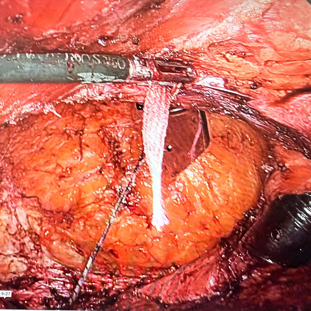 Mahadar (Mumbai) Hybrid Intraop 1