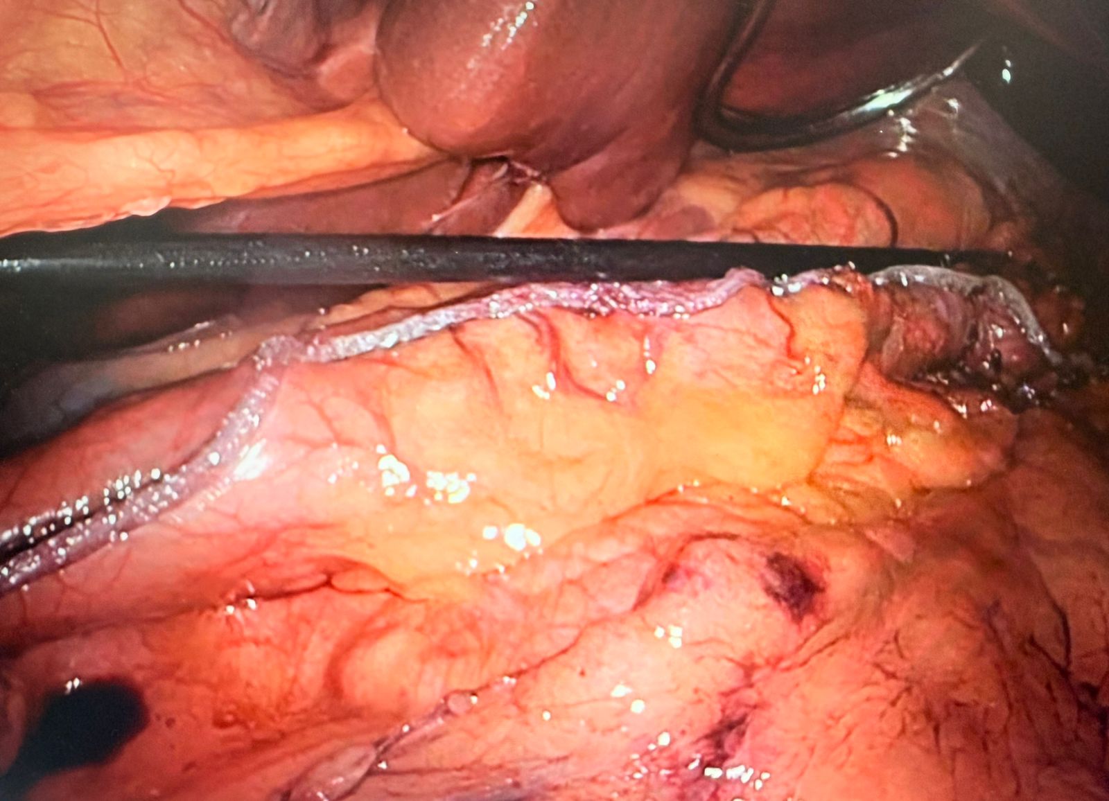 Mahadar (Mumbai) Hybrid Intraop 4