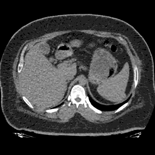 Mumbai-Hybrid-Hernia-Pre-op-CT-Scan-small