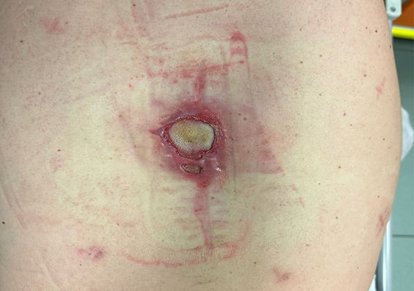 Case Reports Hernia_Infected Mesh Pisa