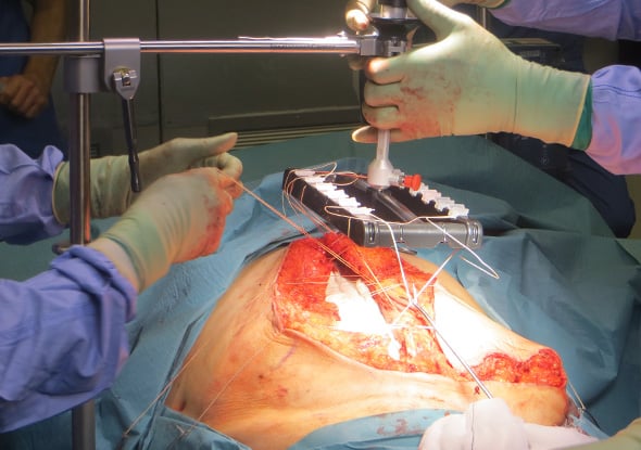 Case Reports Hernia_York